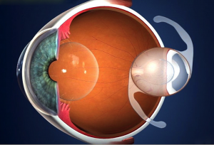 lente intra ocular cirurgia de catarata curitiba