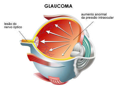 tratamento glaucoma curitiba